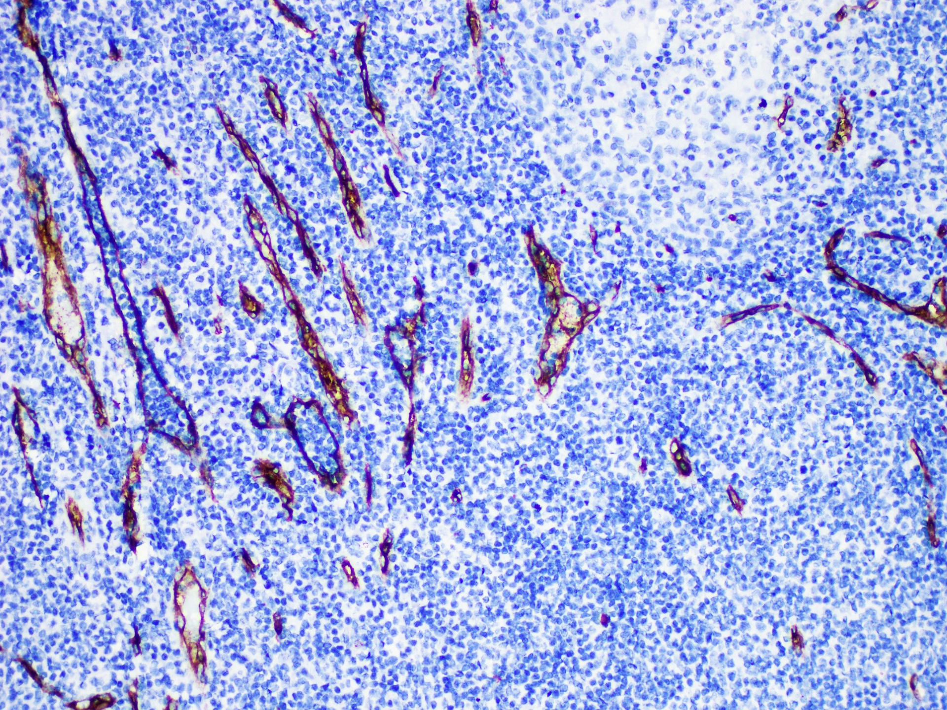 Pathological Antibodies