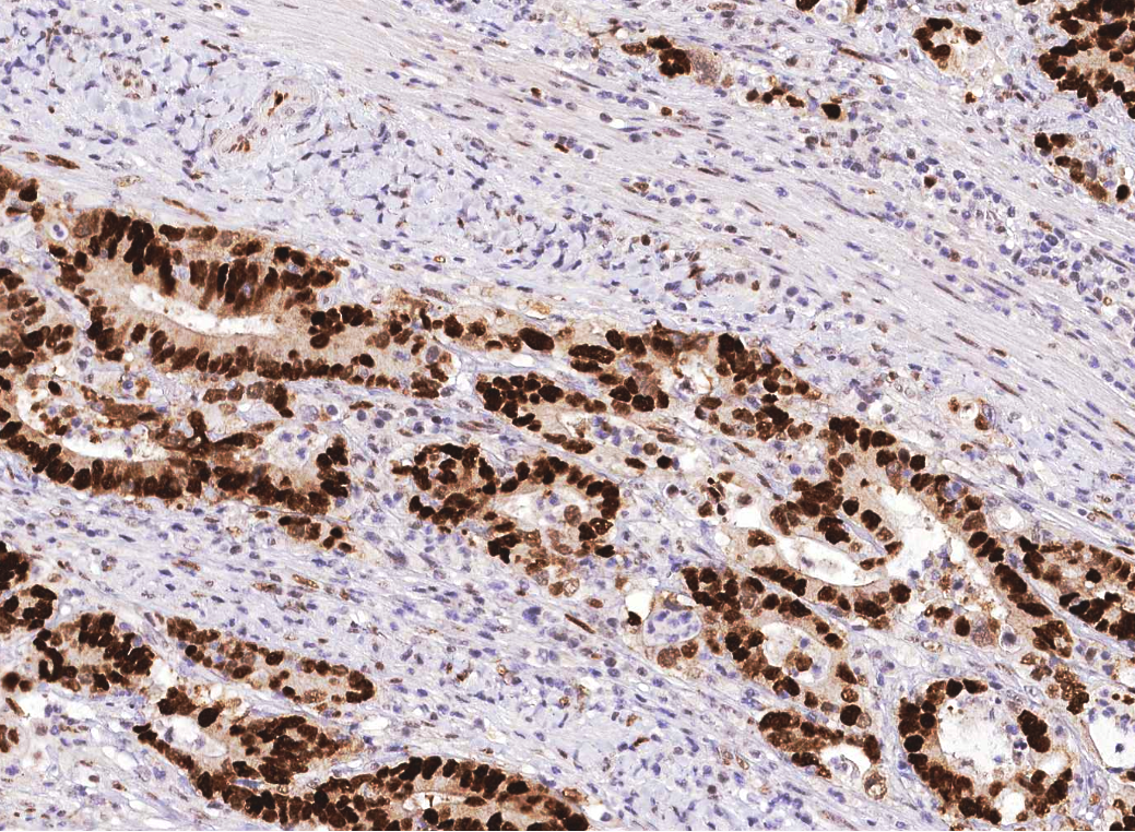 Pathological Antibodies