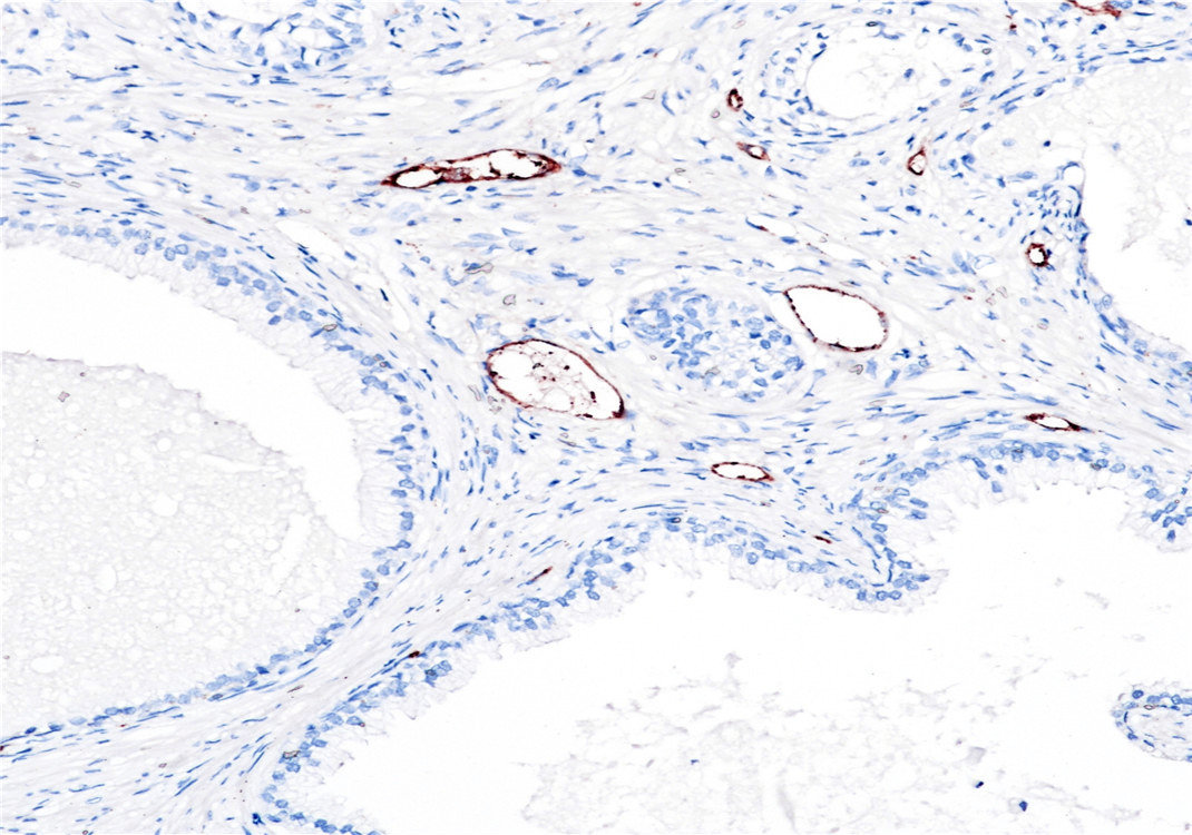 Pathological Antibodies