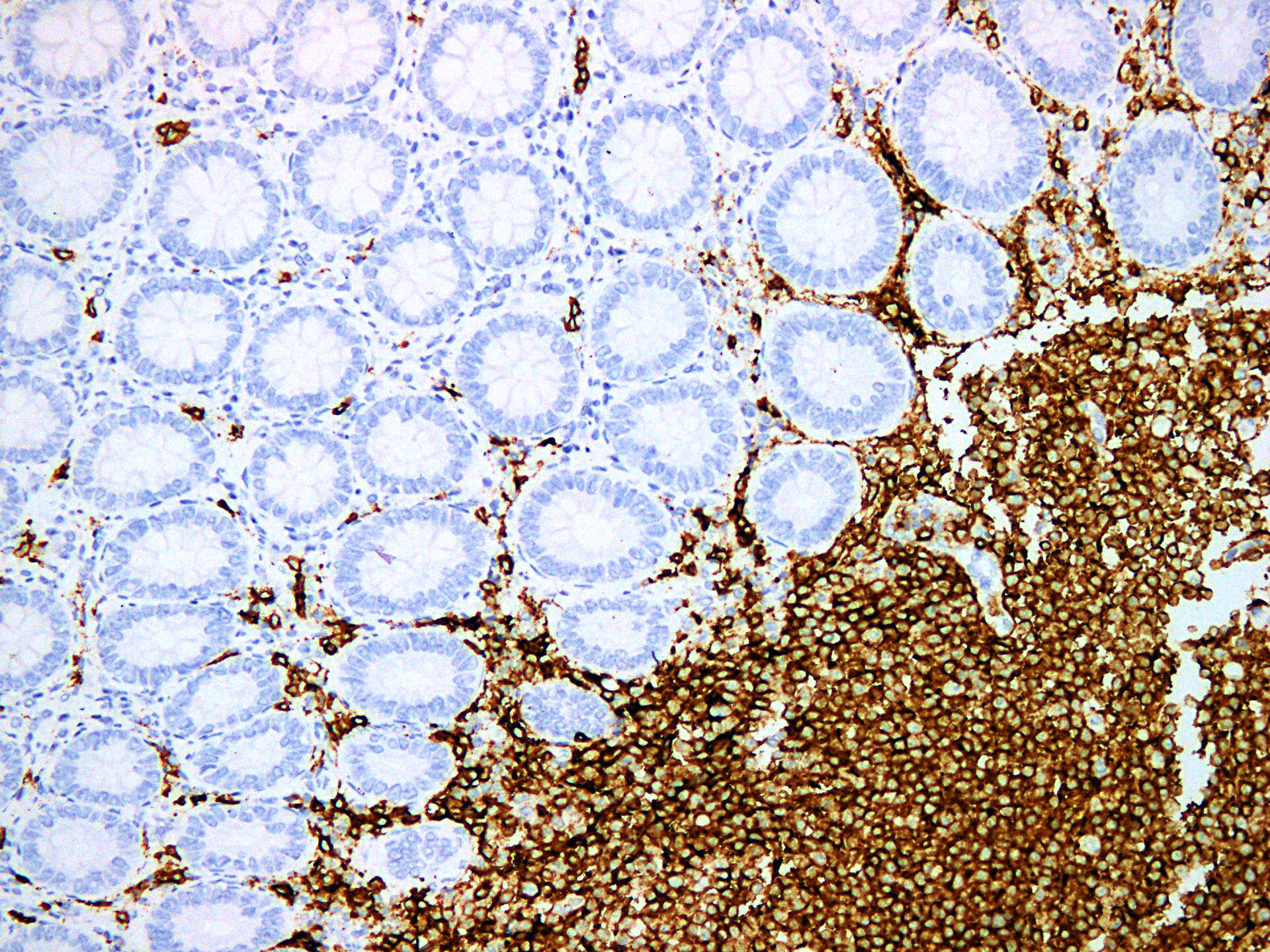 Pathological Antibodies