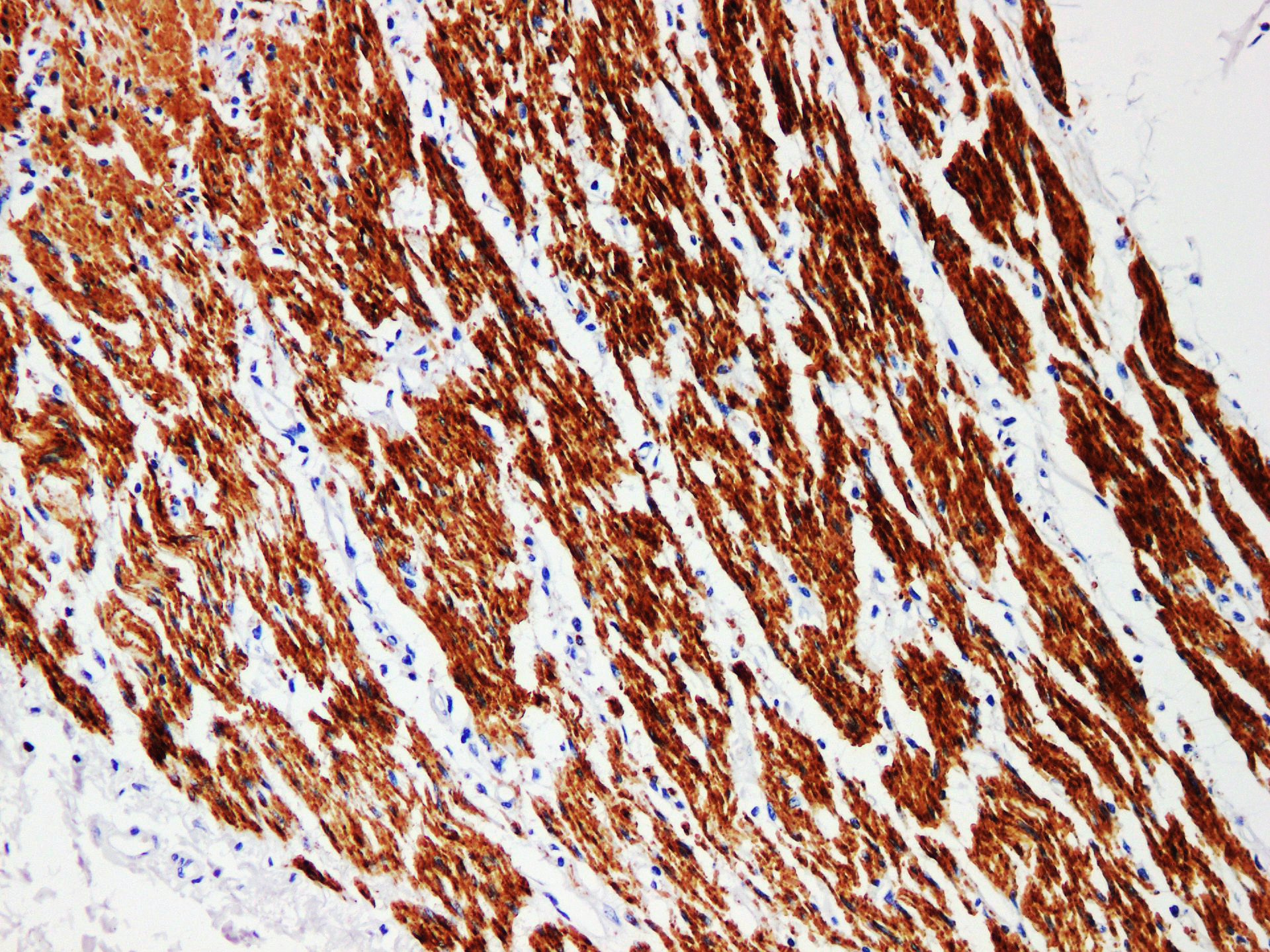 Pathological Antibodies