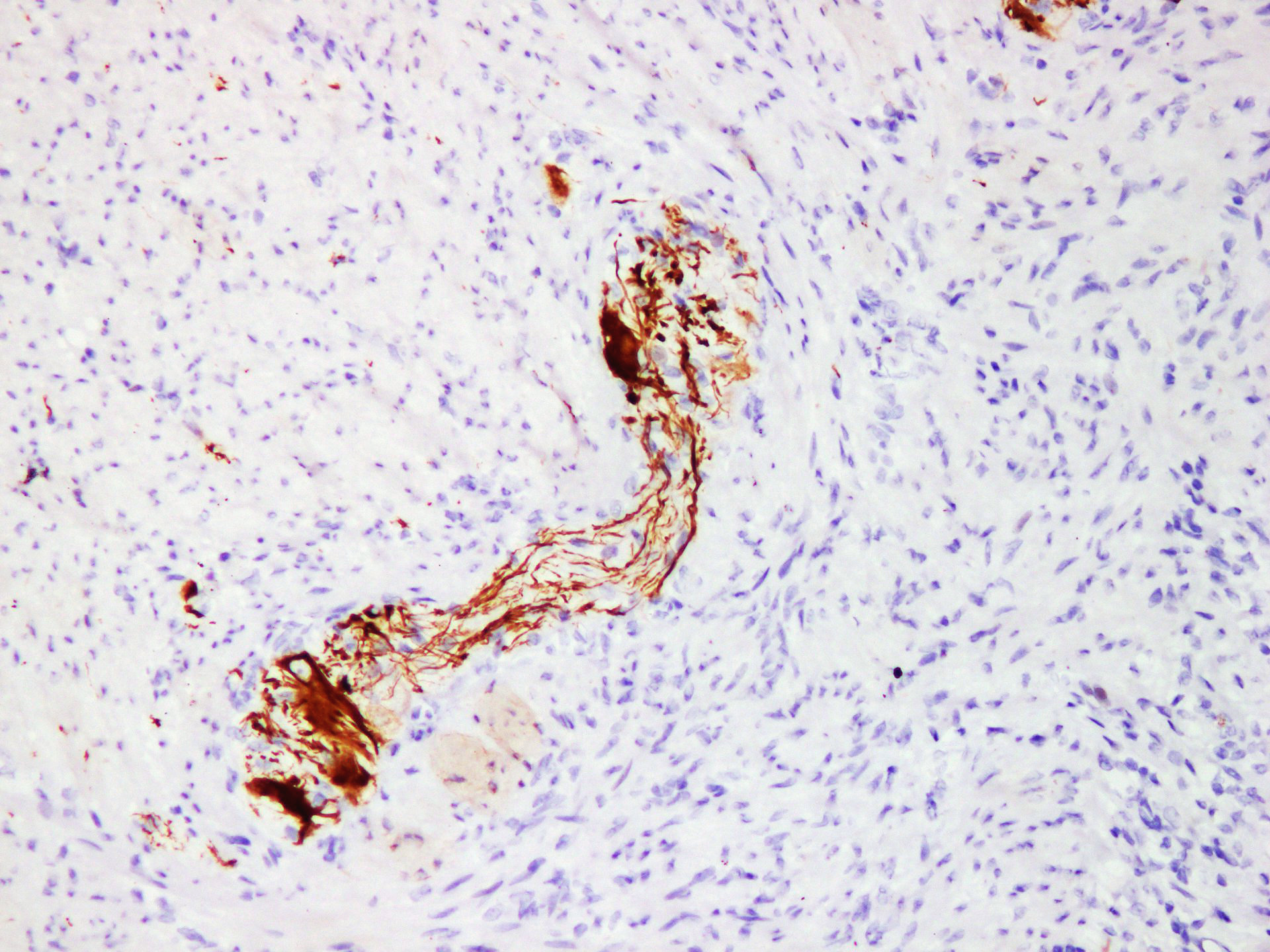 Pathological Antibodies