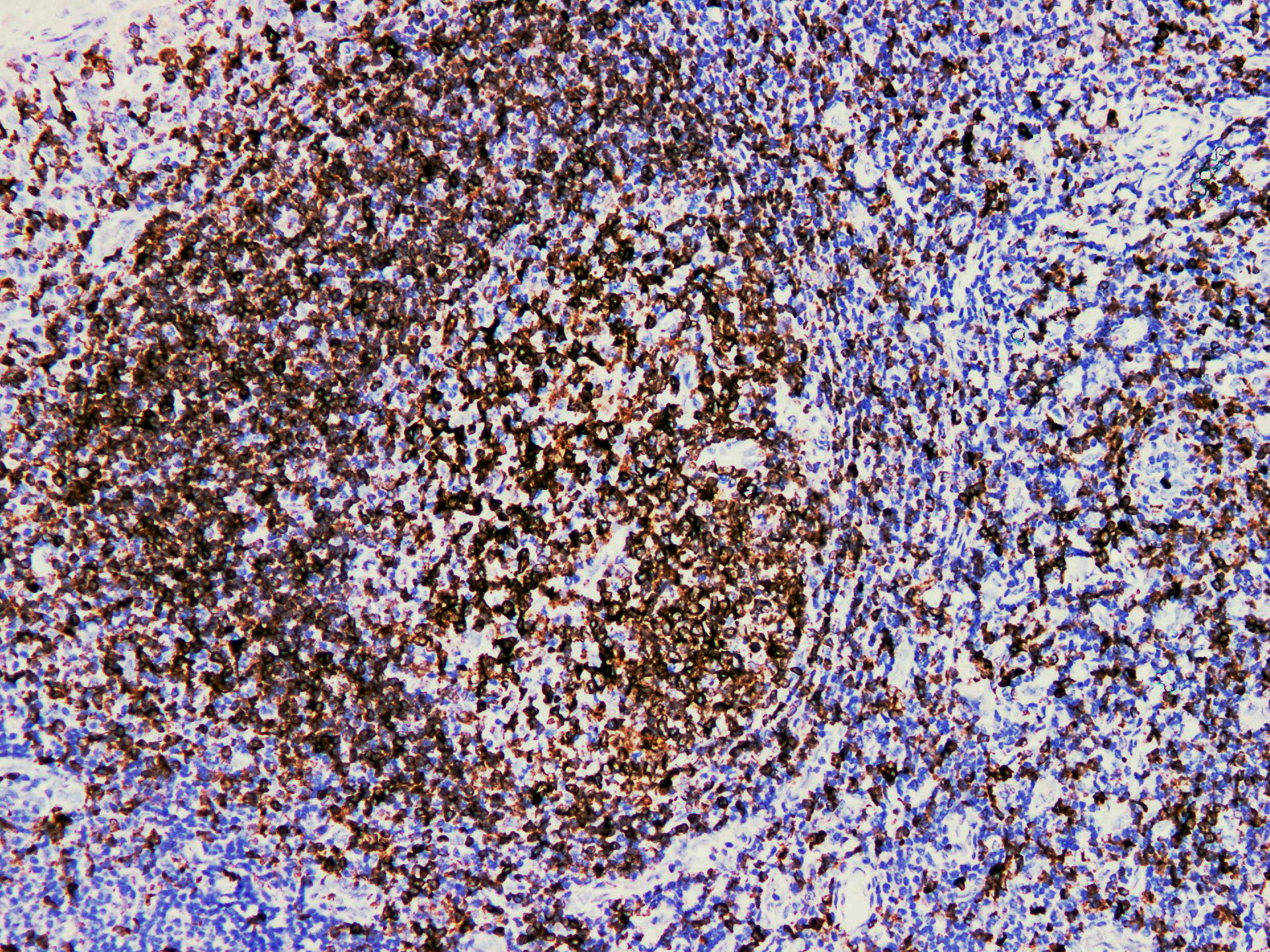 Pathological Antibodies