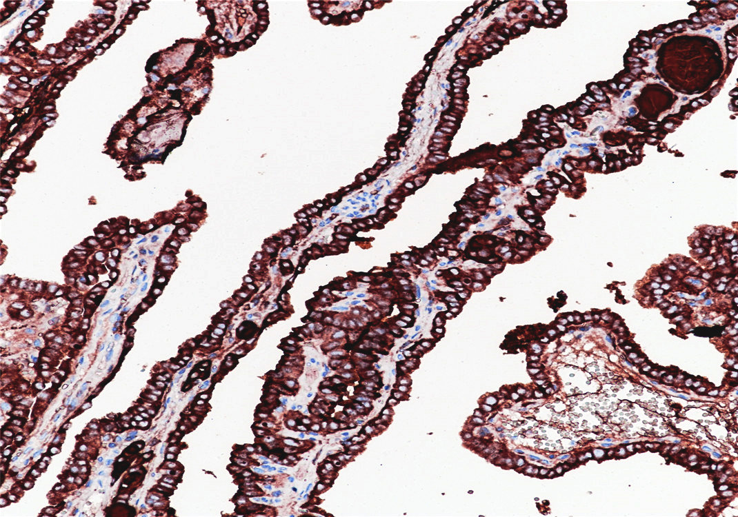 Pathological Antibodies