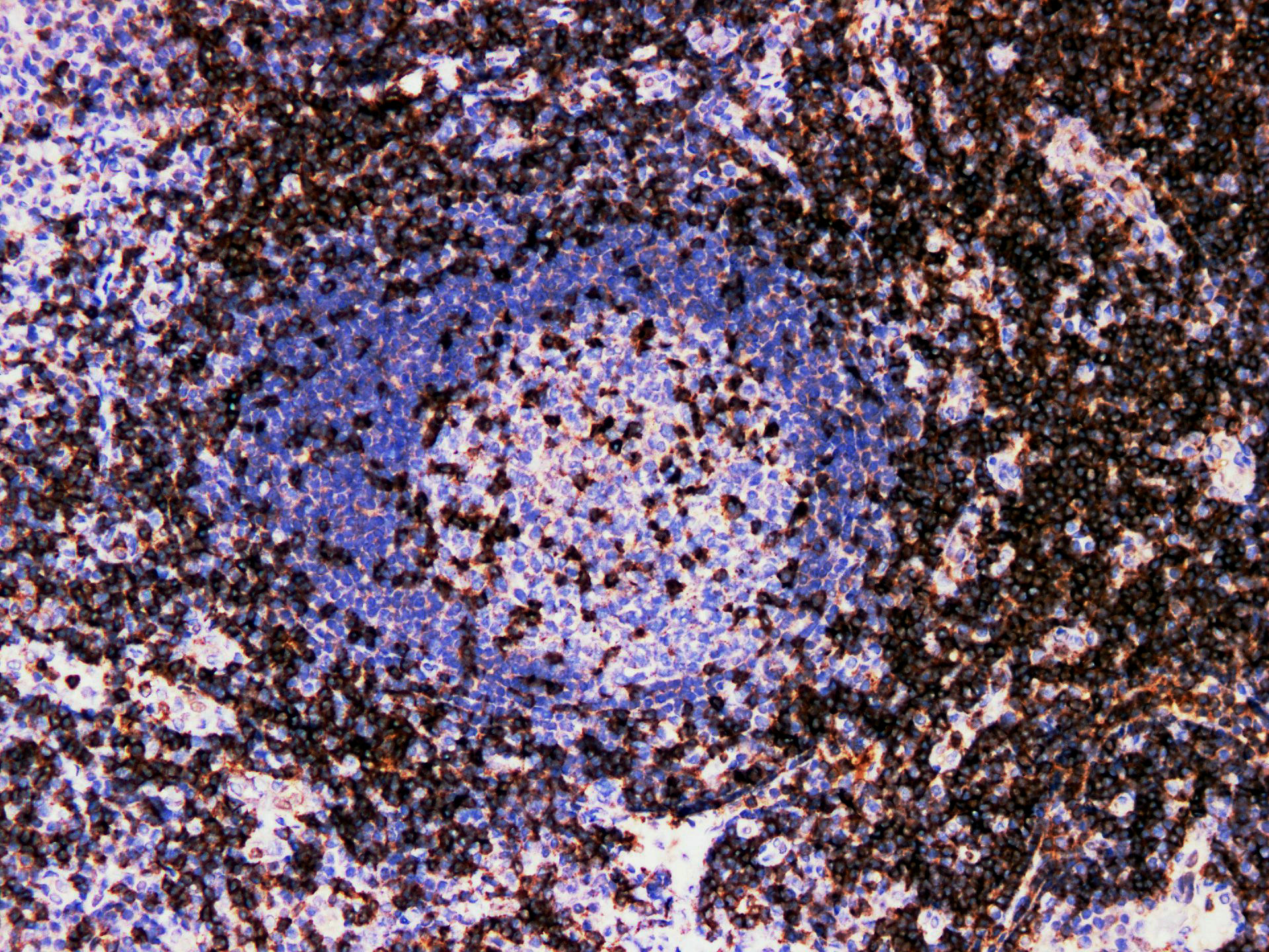 Pathological Antibodies