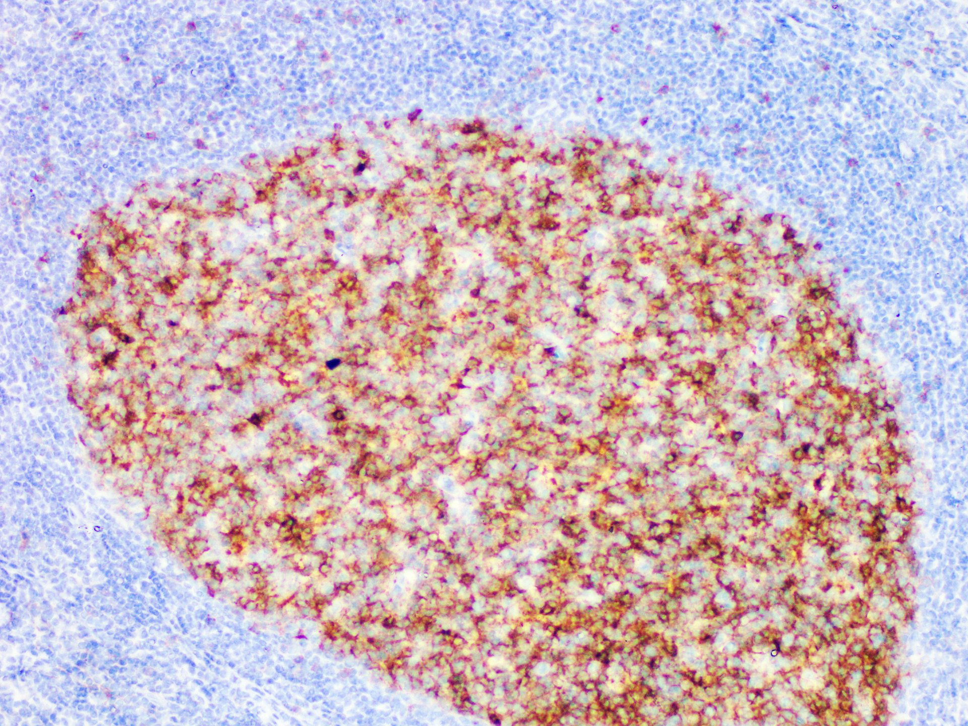 Pathological Antibodies